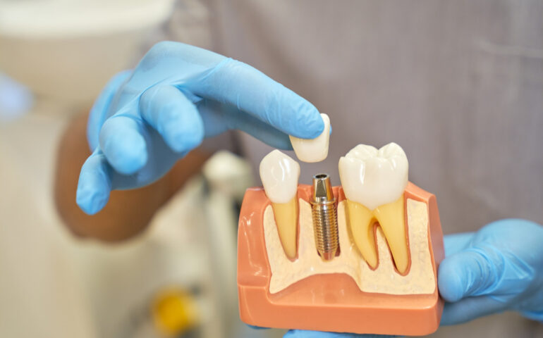 plastic-prop-teeth-implant-being-shown-by-dentist